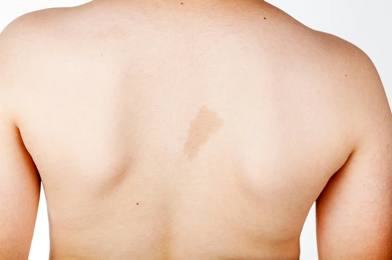 skin discoloration