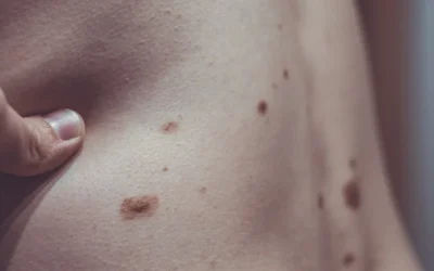 Melanocytic Nevus: Understanding Moles and Skin Health