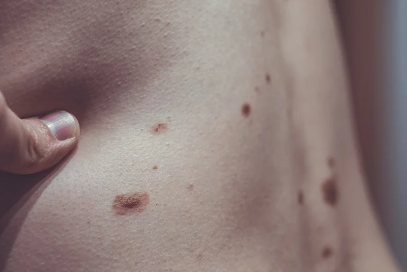 photoviewer (86) (1) melanocytic nevus