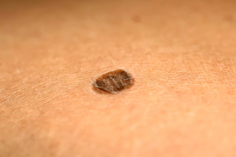 melanocytic nevus