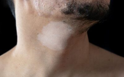Hypopigmentation: Causes, Types, and Treatment