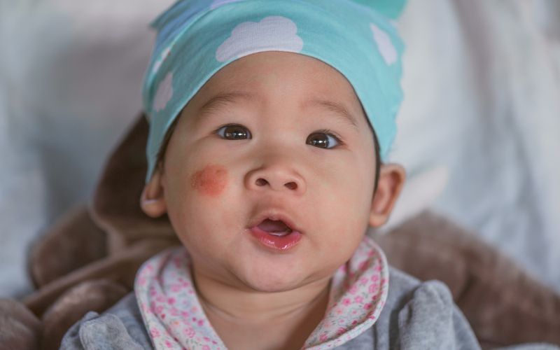 Pityriasis Alba Pityriasis Alba