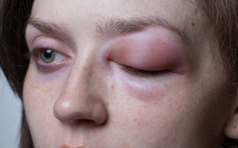 angioedema