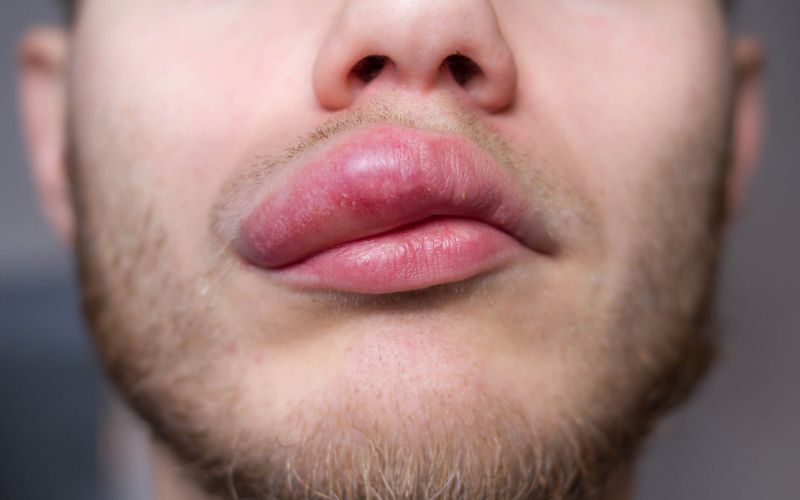 angioedema.