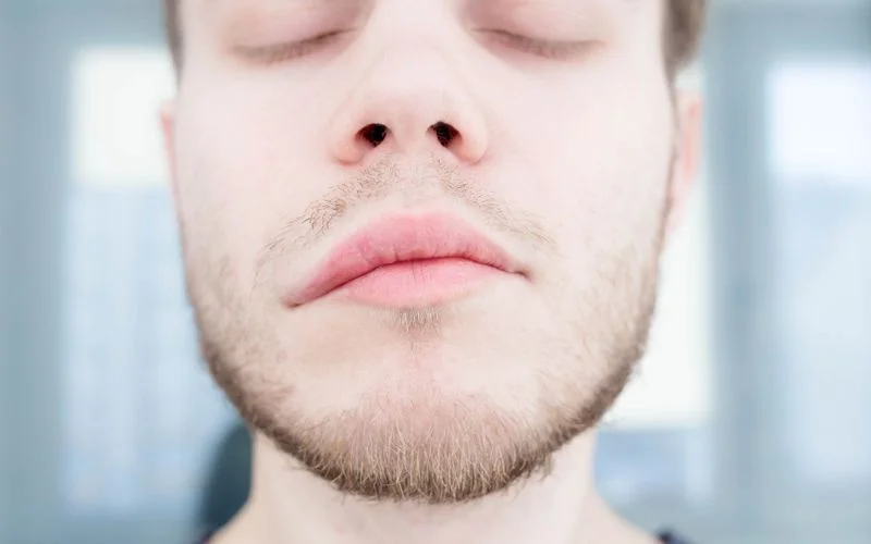 angioedema lips 