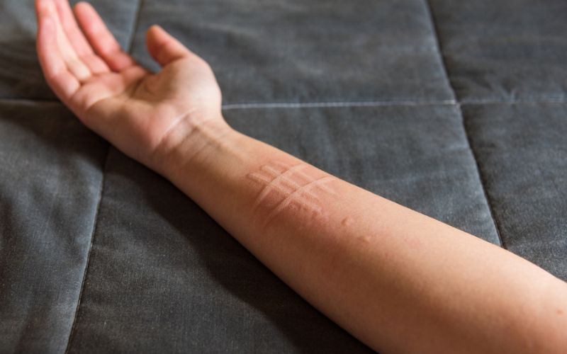 Dermatographic Urticaria
