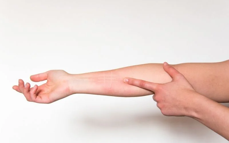 Dermatographic 