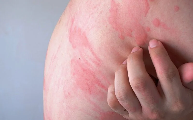 Spontaneous Urticaria
