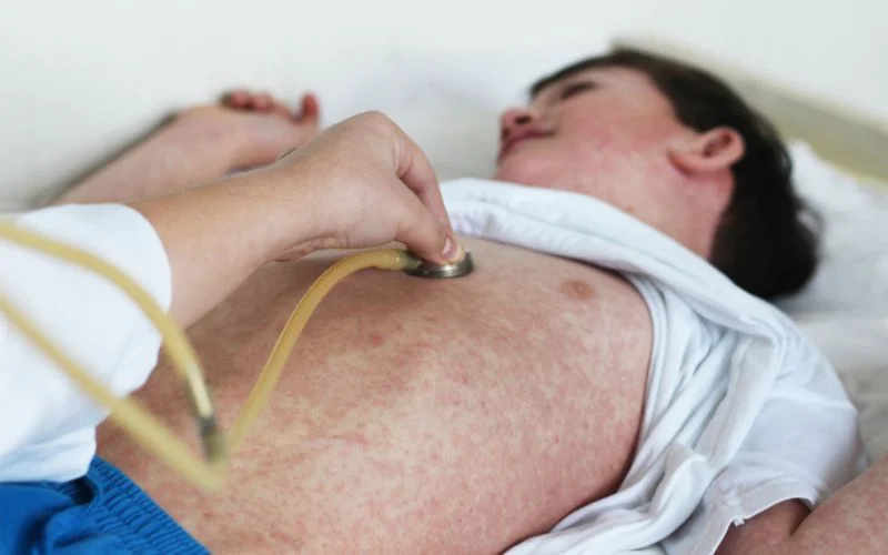 Chronic Urticaria