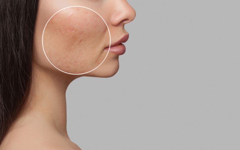 darkspots