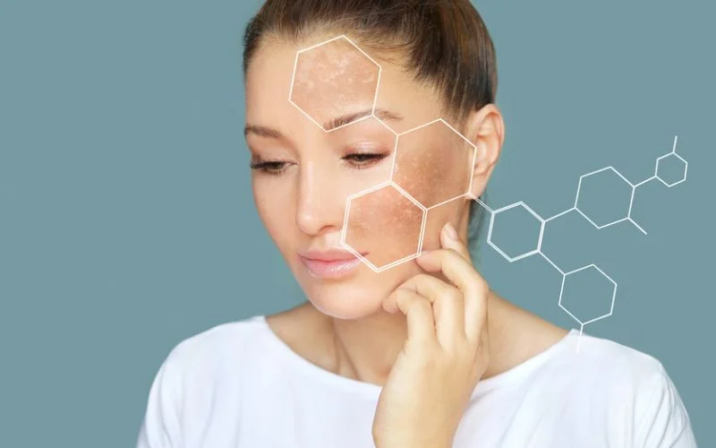 Hyperpigmentation