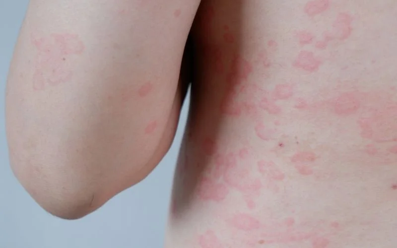 Hives