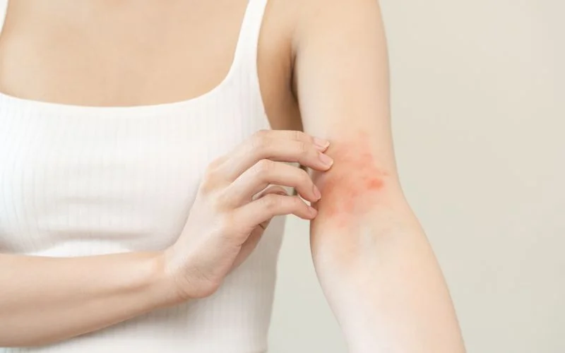 Eczema
