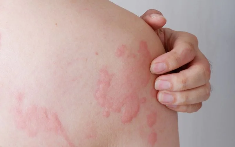 Hives