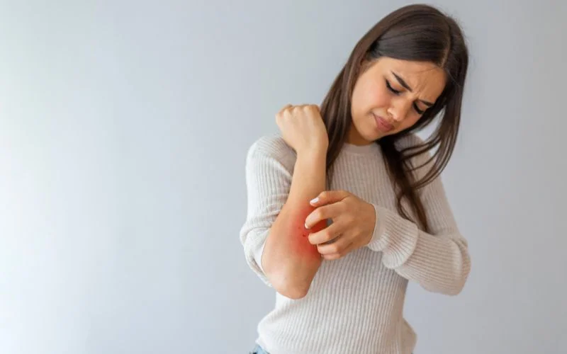 Eczema and Hives