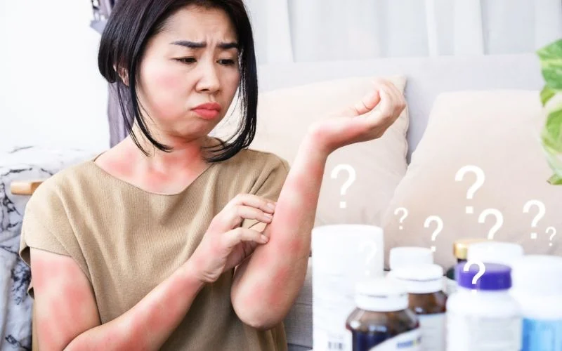 Hives and Their Causes